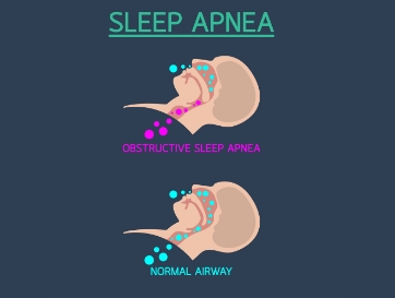 best obstructive sleep apnea in banaglore